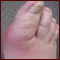 Gout